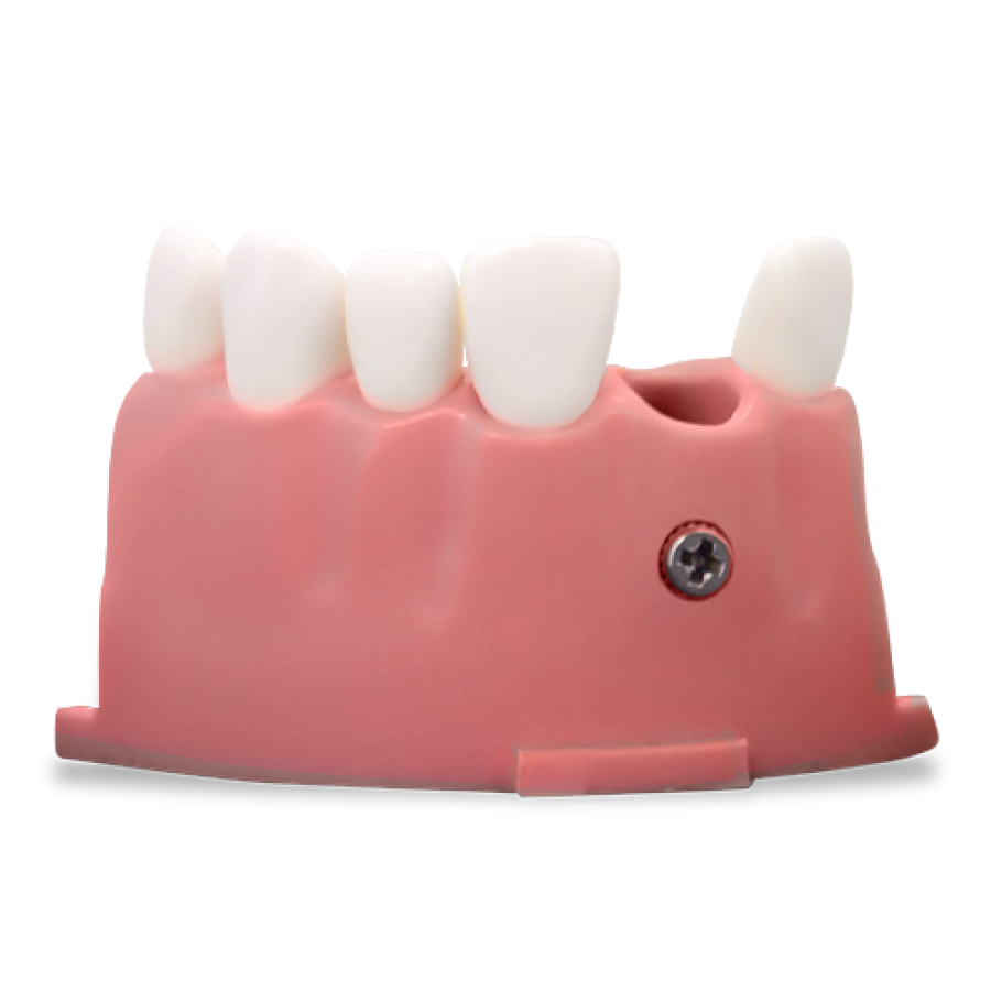 RT OS3 (Endo/Pros) Upper Anterior Mod 07‑12 w/M300 Teeth